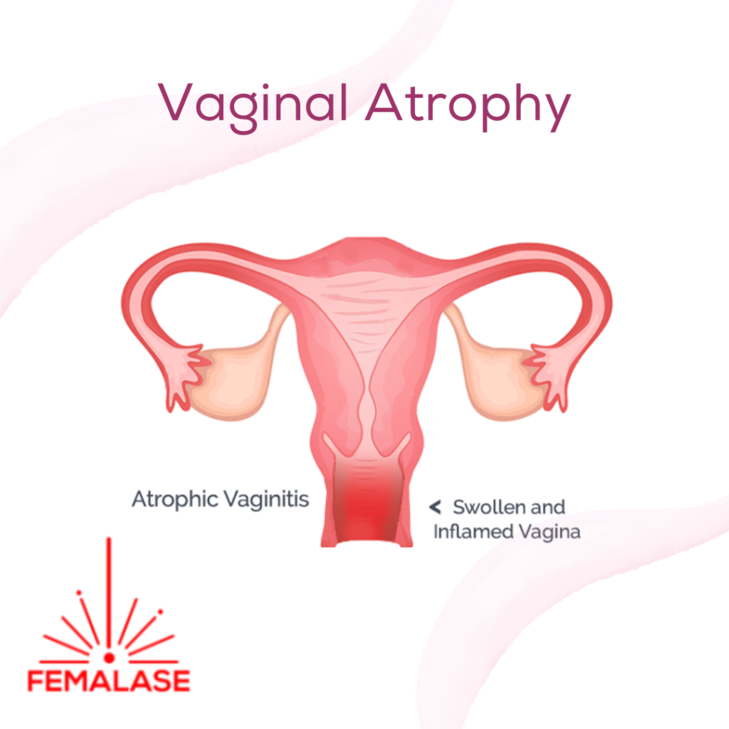 Understanding Vaginal Atrophy